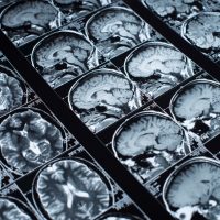 Workplace Concussion Claims in Arvada, Denver, and Aurora: Why Brain Injury Symptoms Are Often Challenged by Insurers Workplace Concussion Claims in Arvada, Denver, and Aurora: Why Brain Injury Symptoms Are Often Challenged by Insurers